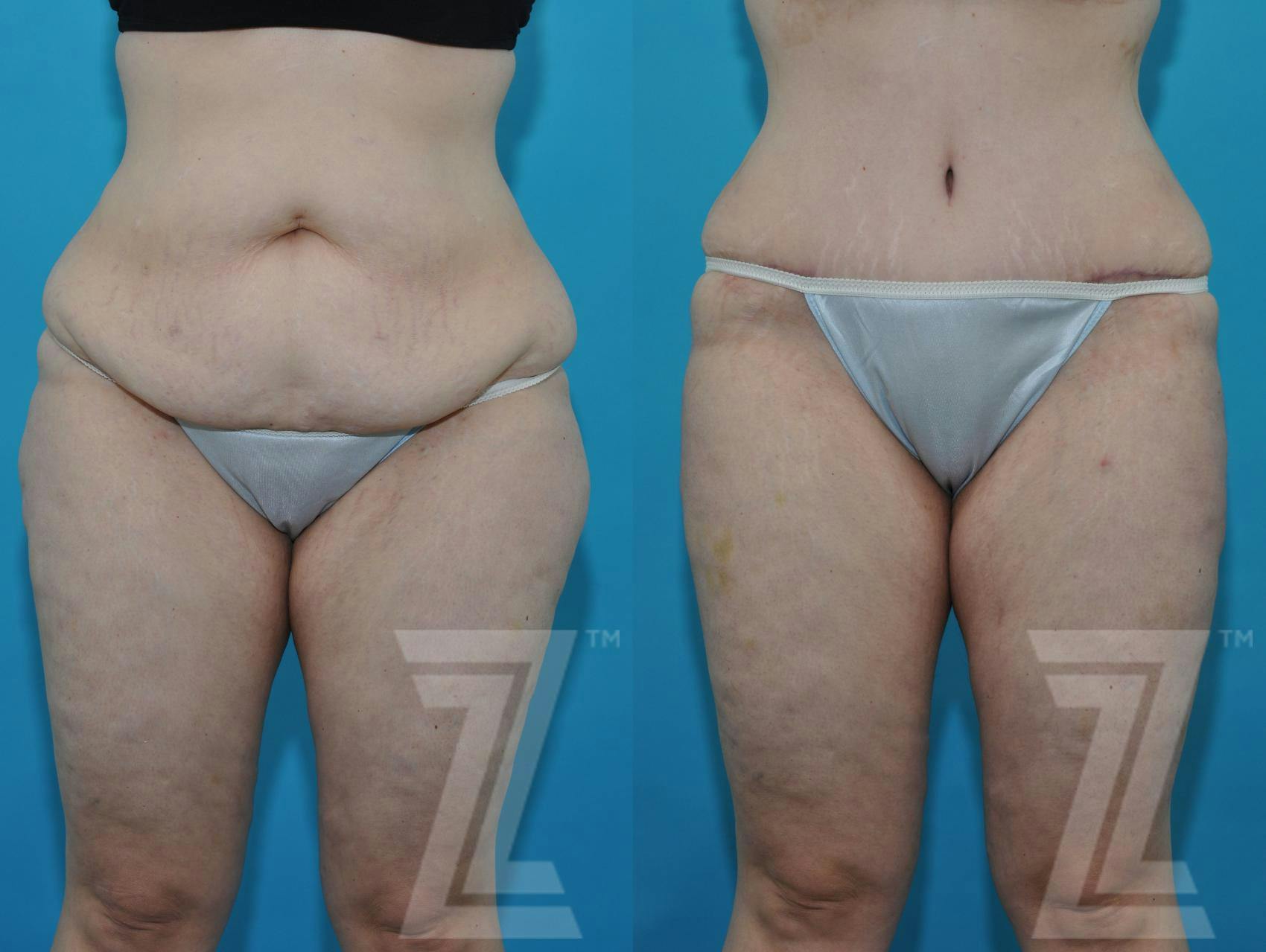 Tummy Tuck Before & After Gallery - Patient 132886824 - Image 7