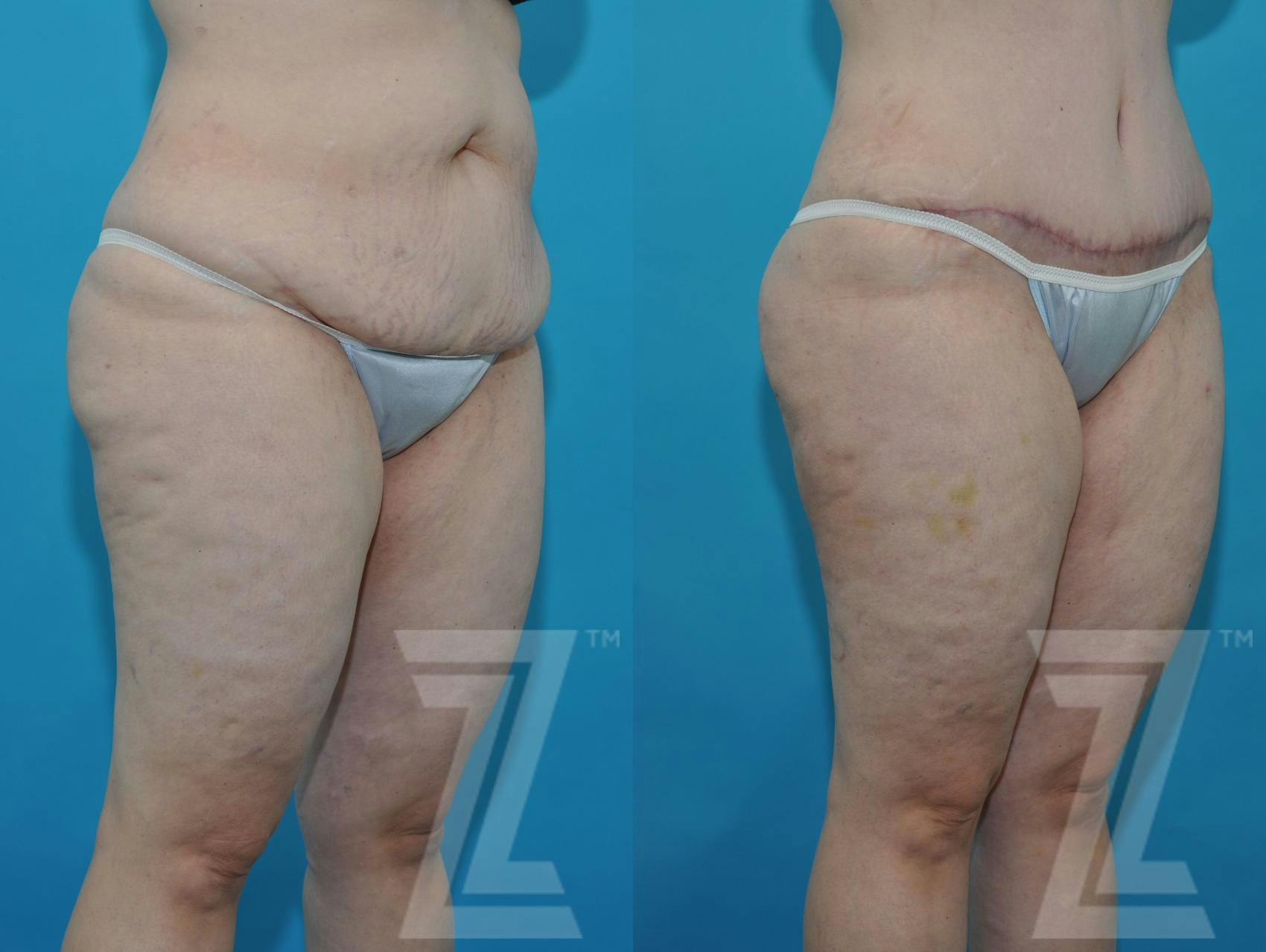 Tummy Tuck Before & After Gallery - Patient 132886824 - Image 9