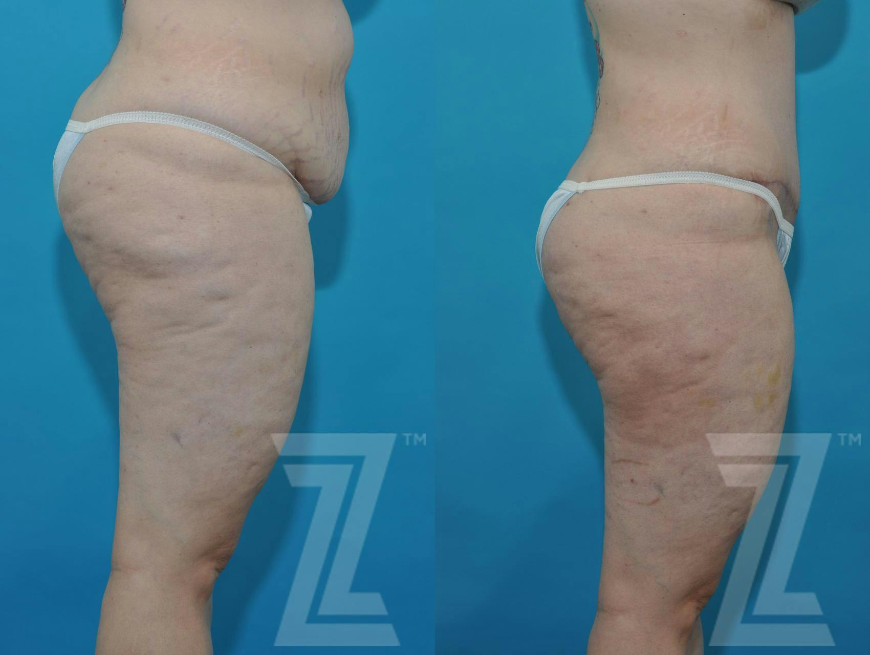 Tummy Tuck Before & After Gallery - Patient 132886824 - Image 10