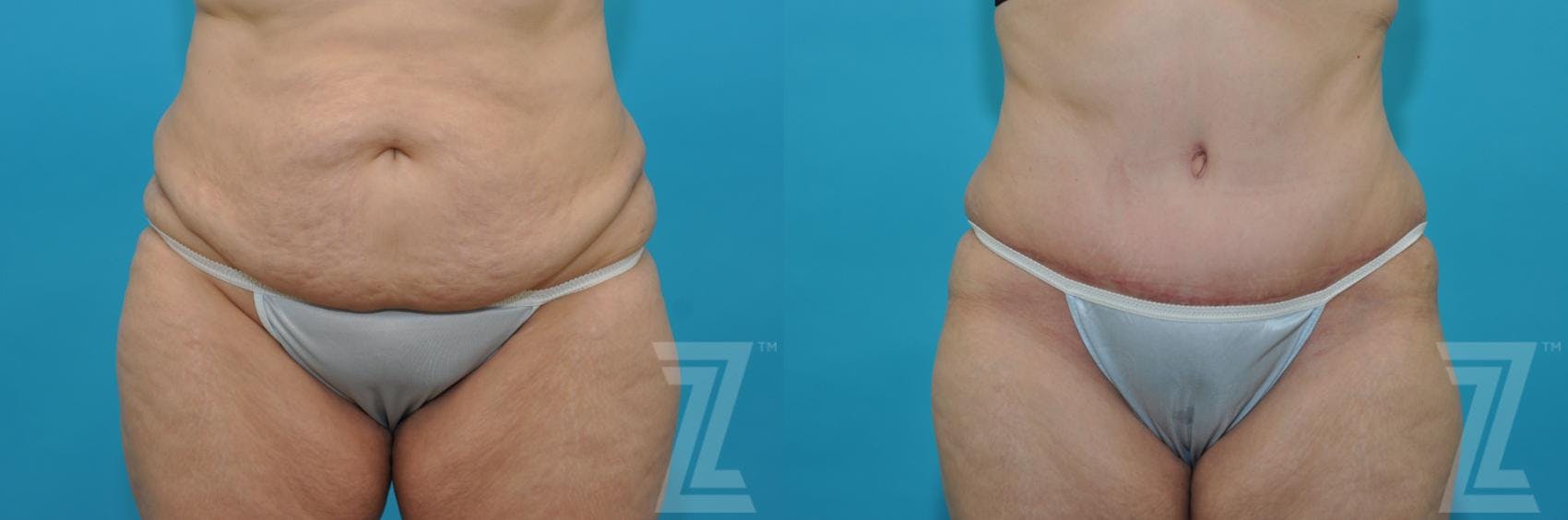 Tummy Tuck Before & After Gallery - Patient 132886829 - Image 1