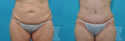 Tummy Tuck Before & After Gallery - Patient 132886829 - Image 1