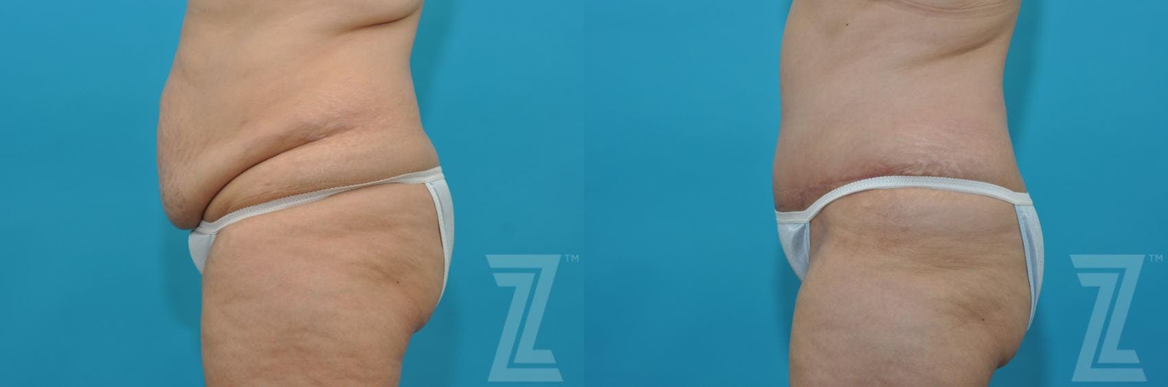 Tummy Tuck Before & After Gallery - Patient 132886829 - Image 2