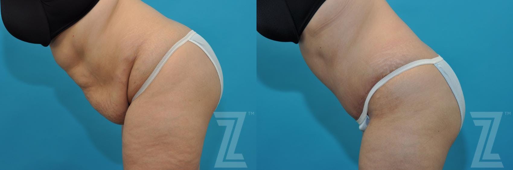 Tummy Tuck Before & After Gallery - Patient 132886829 - Image 3