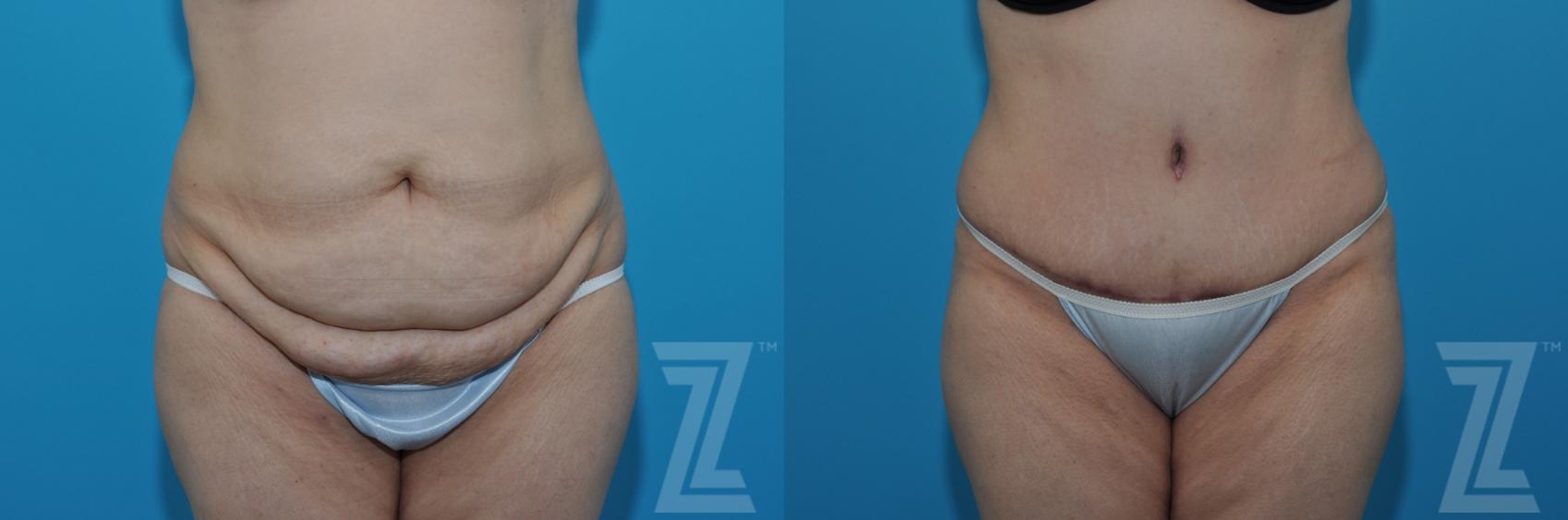 Austin Tummy Tuck Before & After Gallery - Patient 132886862 - Image 1 - The Piazza Center