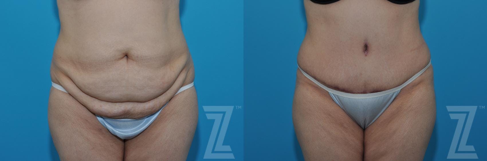 Tummy Tuck Before & After Gallery - Patient 132886862 - Image 1