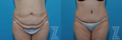 Austin Tummy Tuck Before & After Gallery - Patient 132886862 - Image 1 - The Piazza Center