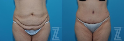Tummy Tuck Before & After Gallery - Patient 132886862 - Image 1