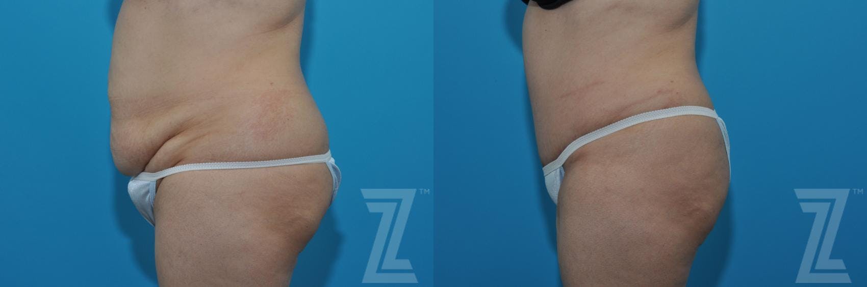 Tummy Tuck Before & After Gallery - Patient 132886862 - Image 2