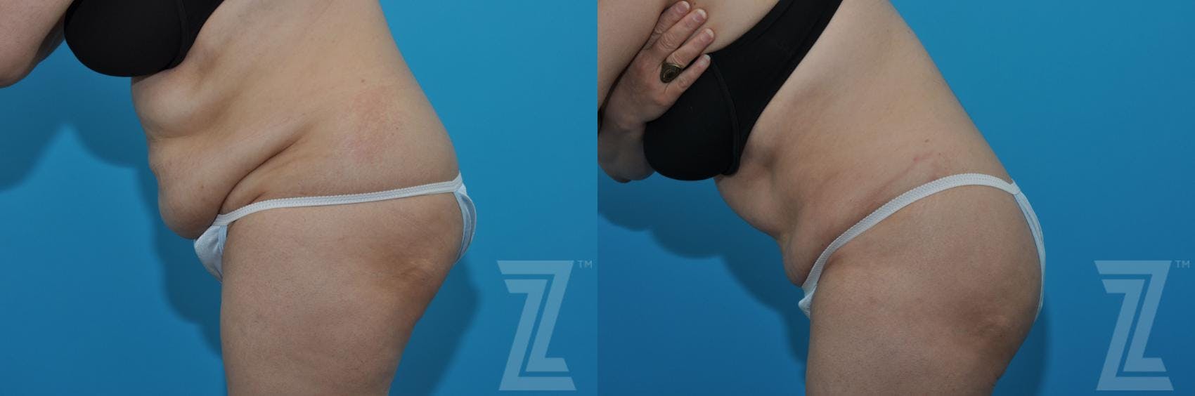 Tummy Tuck Before & After Gallery - Patient 132886862 - Image 3