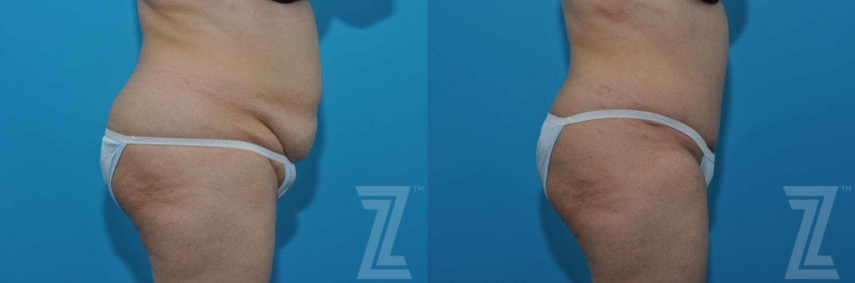 Tummy Tuck Before & After Gallery - Patient 132886862 - Image 4