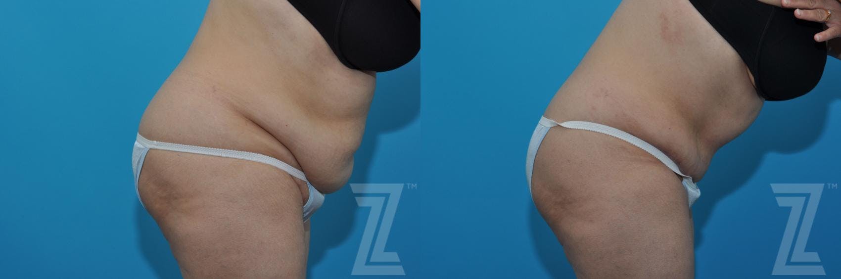 Tummy Tuck Before & After Gallery - Patient 132886862 - Image 5