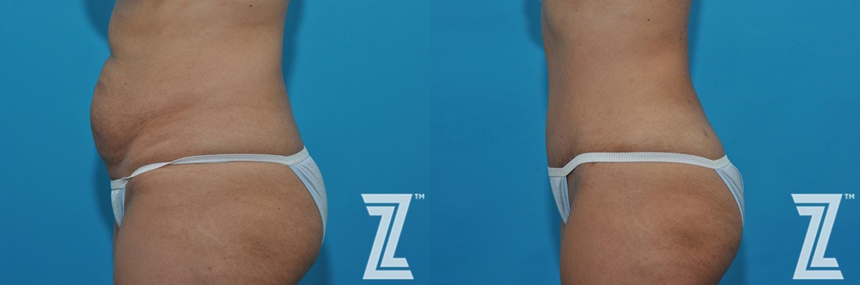 Tummy Tuck Before & After Gallery - Patient 132886863 - Image 3