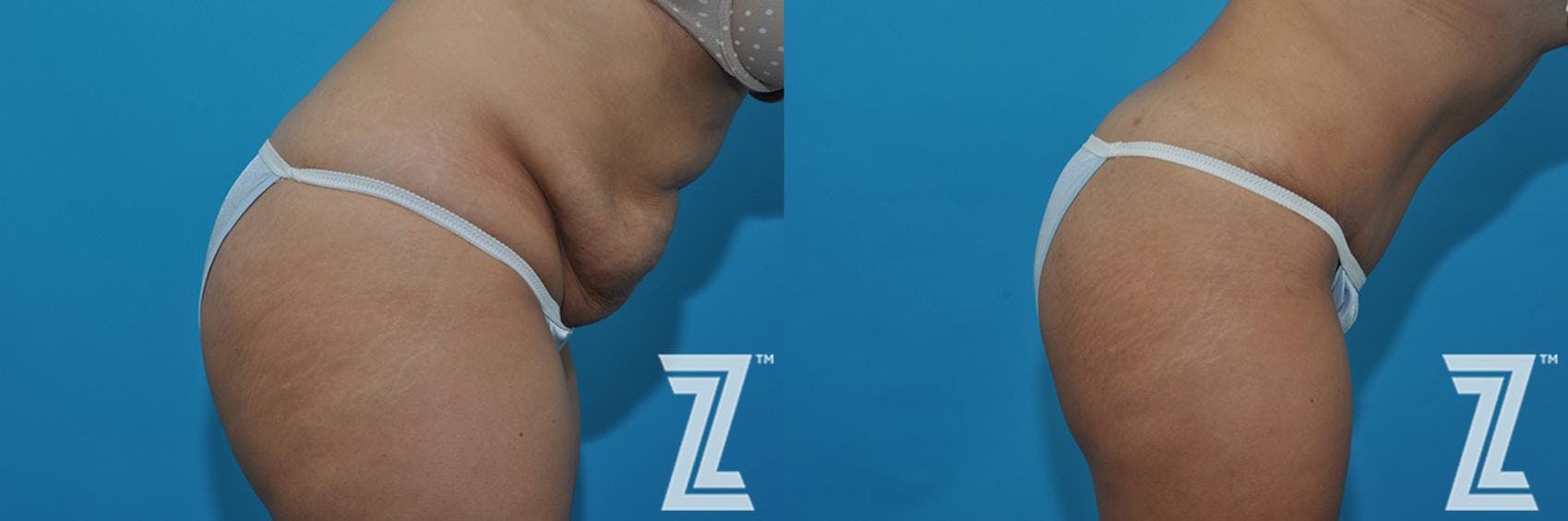 Tummy Tuck Before & After Gallery - Patient 132886863 - Image 6