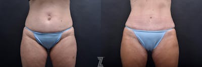 Austin Tummy Tuck Before & After Gallery - Patient 132886865 - Image 1 - The Piazza Center