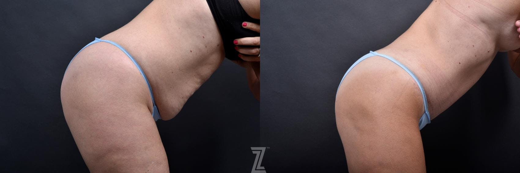 Tummy Tuck Before & After Gallery - Patient 132886865 - Image 5