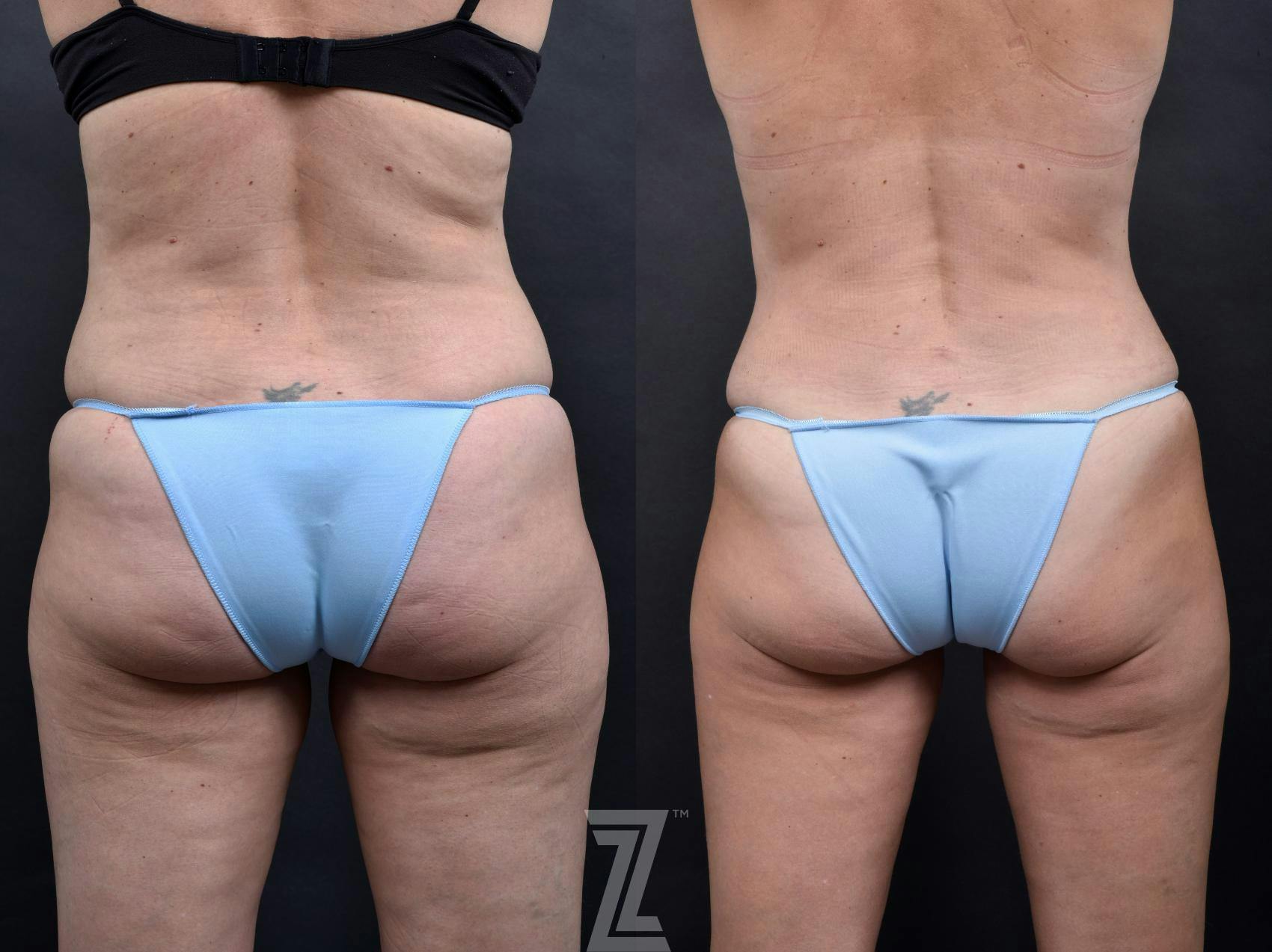 Tummy Tuck Before & After Gallery - Patient 132886865 - Image 6