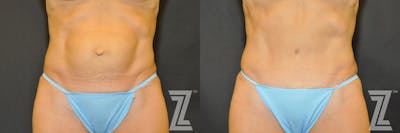 Austin Tummy Tuck Before & After Gallery - Patient 132886866 - Image 1 - The Piazza Center