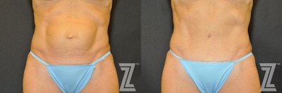 Tummy Tuck Before & After Gallery - Patient 132886866 - Image 1