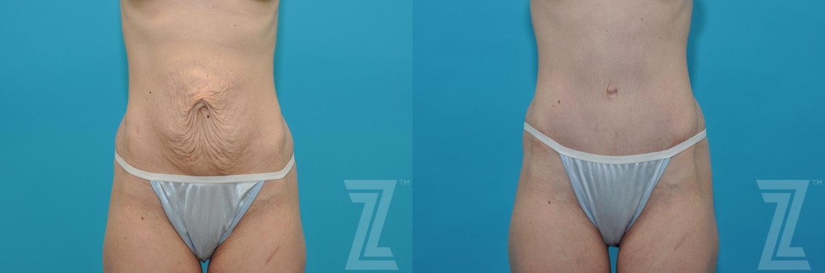 Austin Tummy Tuck Before & After Gallery - Patient 132886867 - Image 1 - The Piazza Center