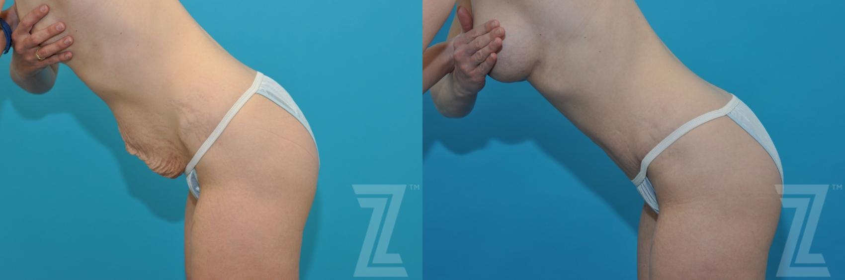 Tummy Tuck Before & After Gallery - Patient 132886867 - Image 3