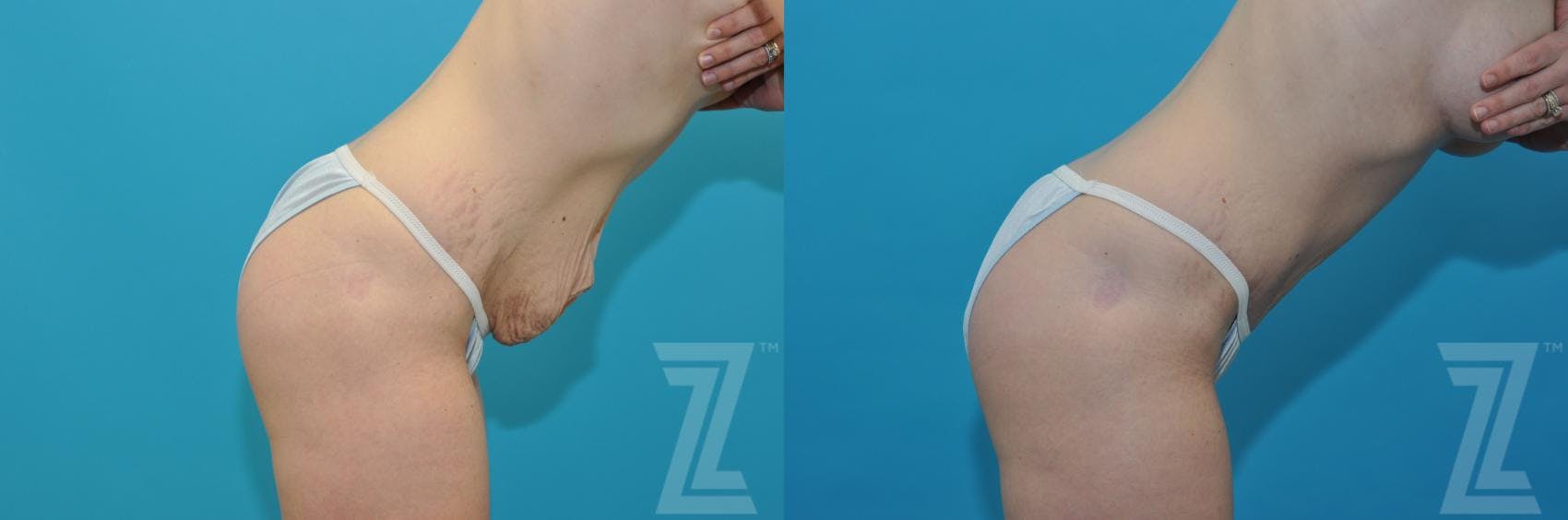 Tummy Tuck Before & After Gallery - Patient 132886867 - Image 5