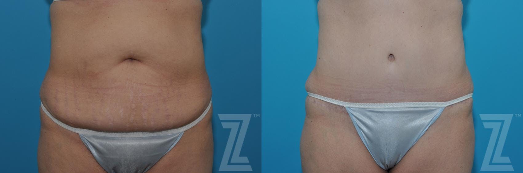 Tummy Tuck Before & After Gallery - Patient 132886869 - Image 1