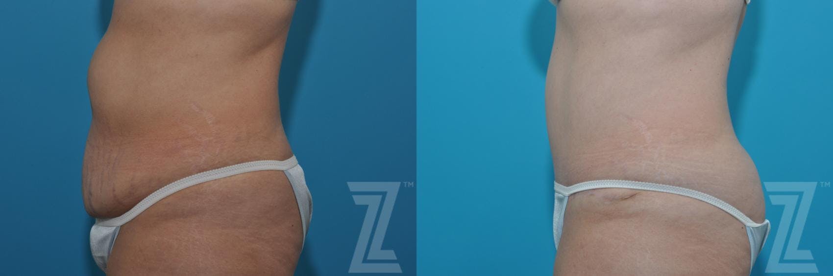 Tummy Tuck Before & After Gallery - Patient 132886869 - Image 2