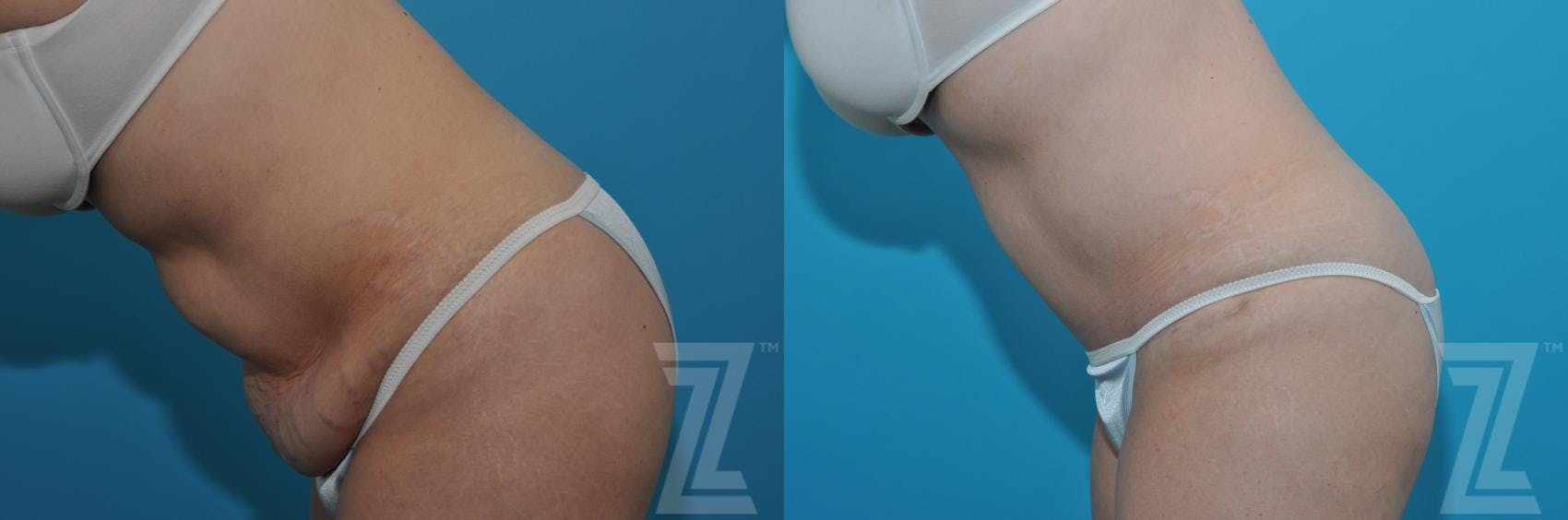 Tummy Tuck Before & After Gallery - Patient 132886869 - Image 3