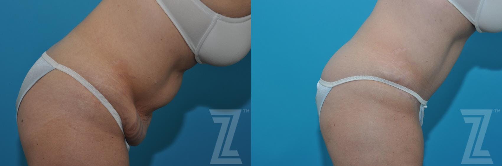 Tummy Tuck Before & After Gallery - Patient 132886869 - Image 5