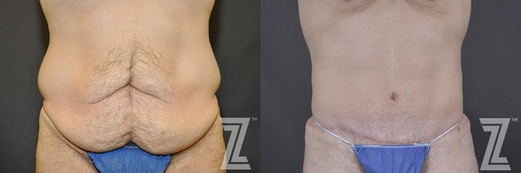 Tummy Tuck Before & After Gallery - Patient 132886870 - Image 1
