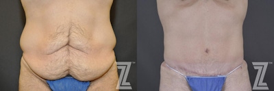 Tummy Tuck Before & After Gallery - Patient 132886870 - Image 1