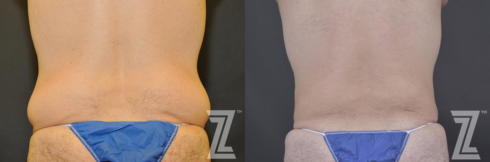 Tummy Tuck Before & After Gallery - Patient 132886870 - Image 4