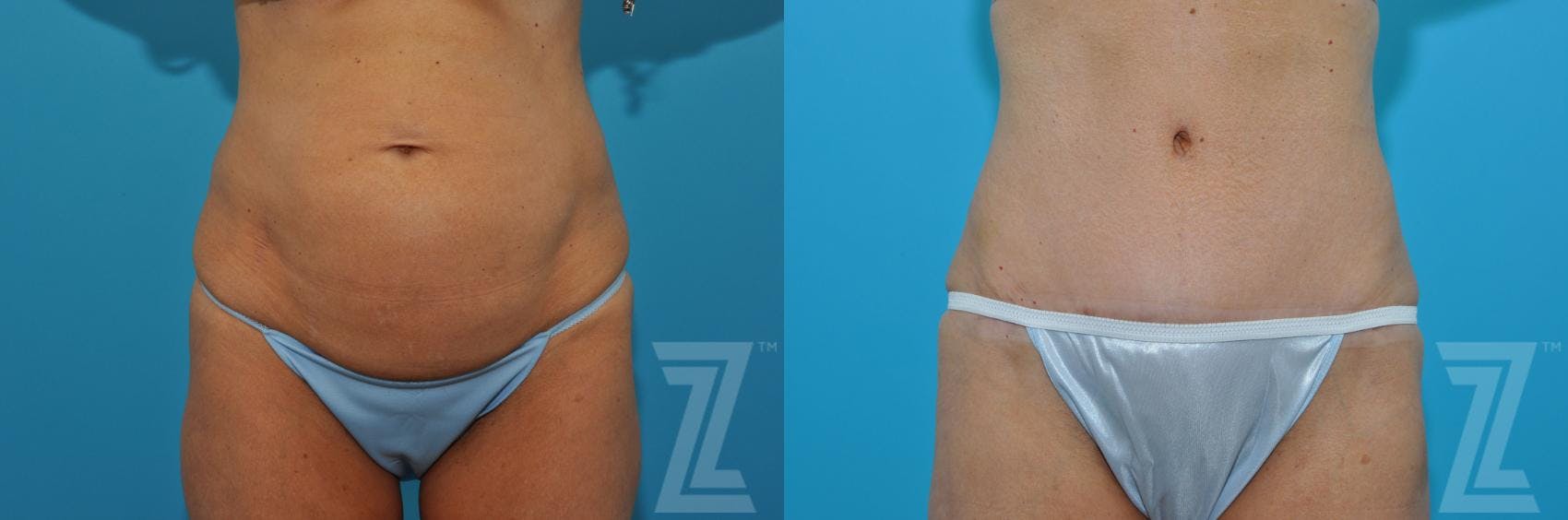 Tummy Tuck Before & After Gallery - Patient 132886871 - Image 1