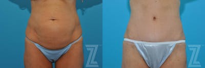 Austin Tummy Tuck Before & After Gallery - Patient 132886871 - Image 1 - The Piazza Center