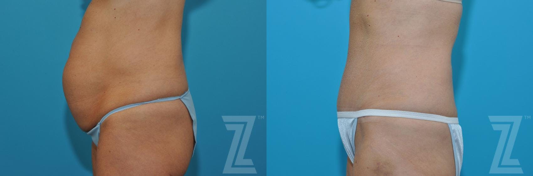 Tummy Tuck Before & After Gallery - Patient 132886871 - Image 2