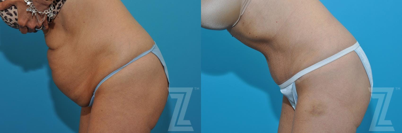 Tummy Tuck Before & After Gallery - Patient 132886871 - Image 3