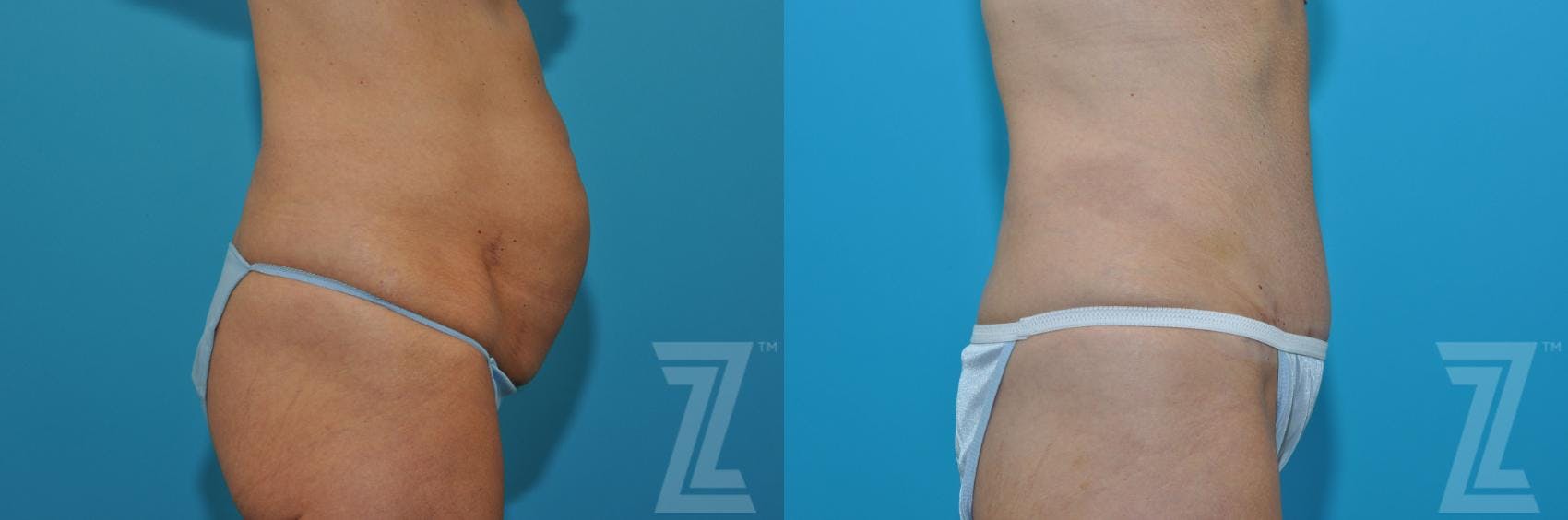 Tummy Tuck Before & After Gallery - Patient 132886871 - Image 4