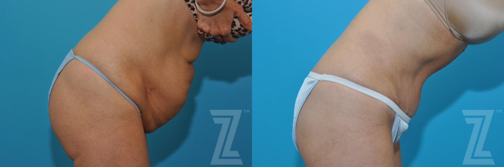 Tummy Tuck Before & After Gallery - Patient 132886871 - Image 5