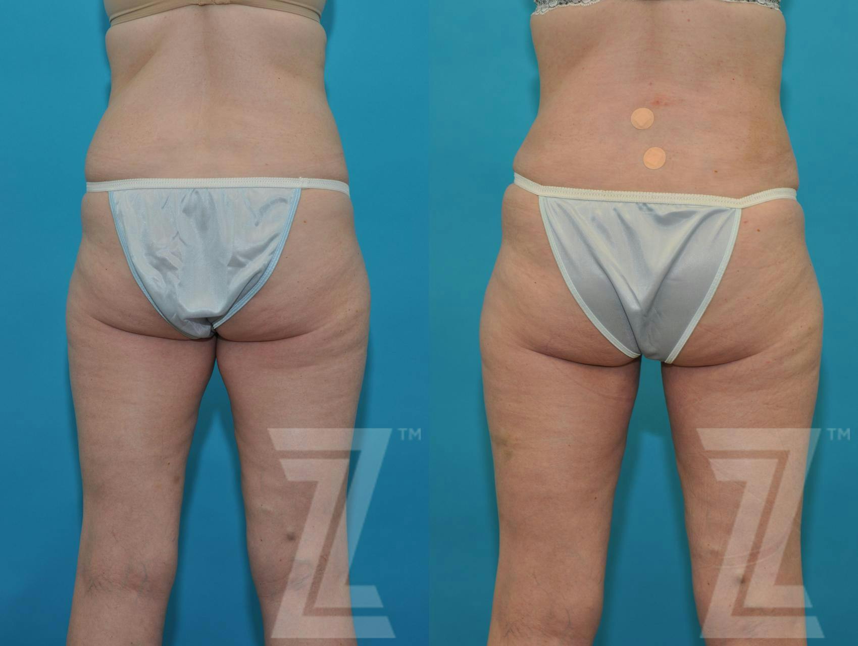 Tummy Tuck Before & After Gallery - Patient 132886874 - Image 2