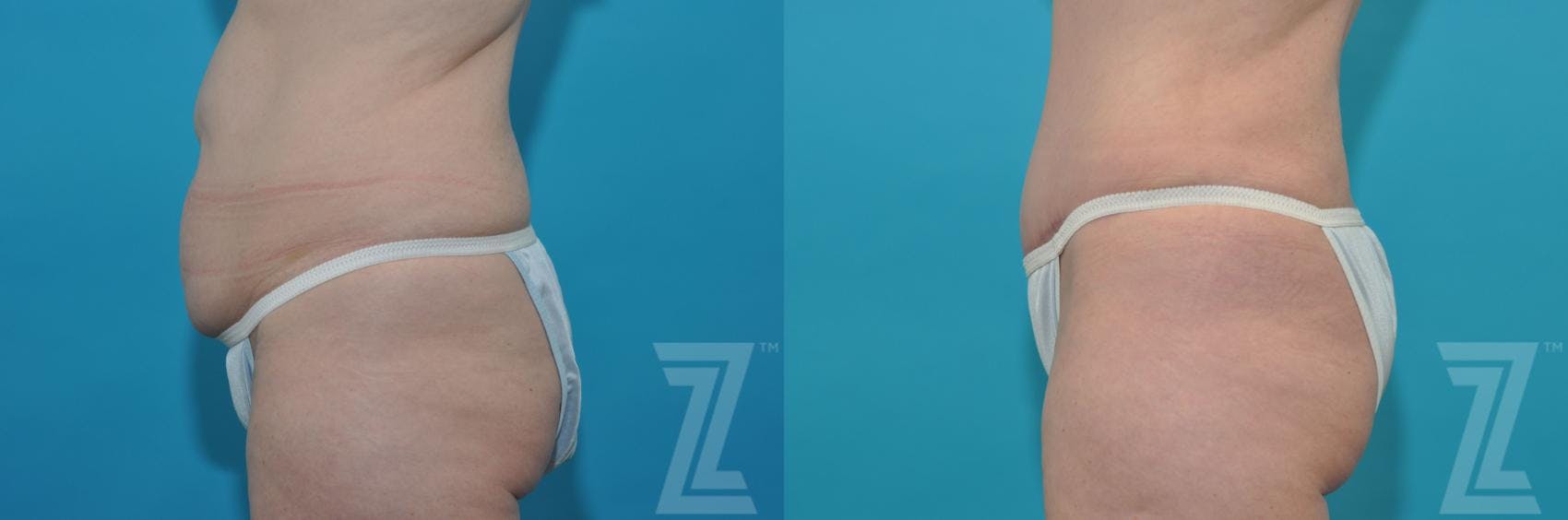Tummy Tuck Before & After Gallery - Patient 132886874 - Image 3