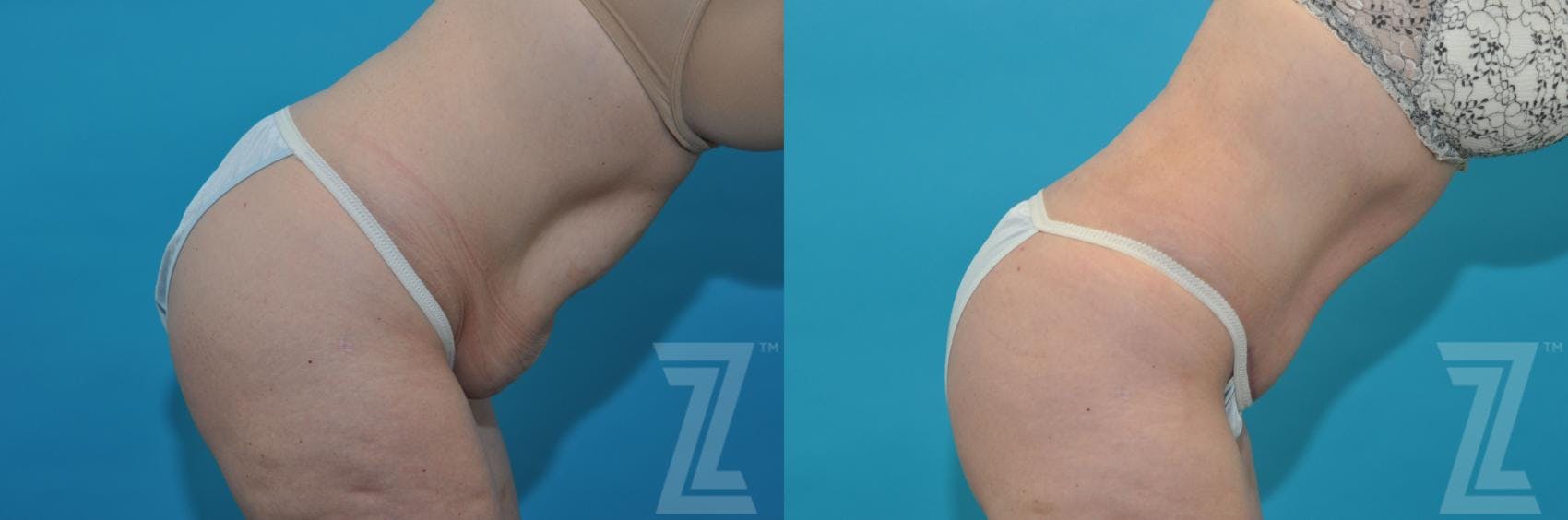 Tummy Tuck Before & After Gallery - Patient 132886874 - Image 6