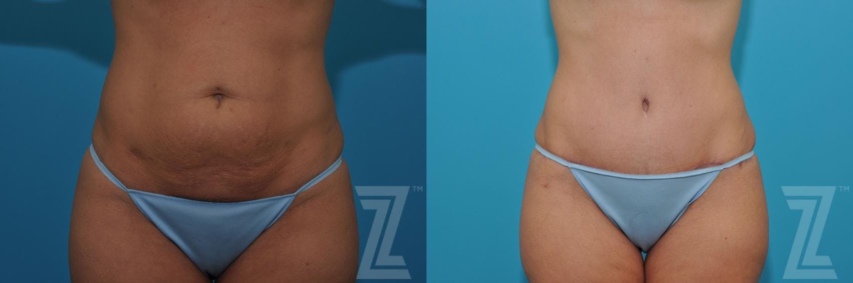 Tummy Tuck Before & After Gallery - Patient 132886876 - Image 1
