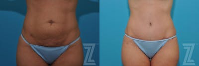 Austin Tummy Tuck Before & After Gallery - Patient 132886876 - Image 1 - The Piazza Center