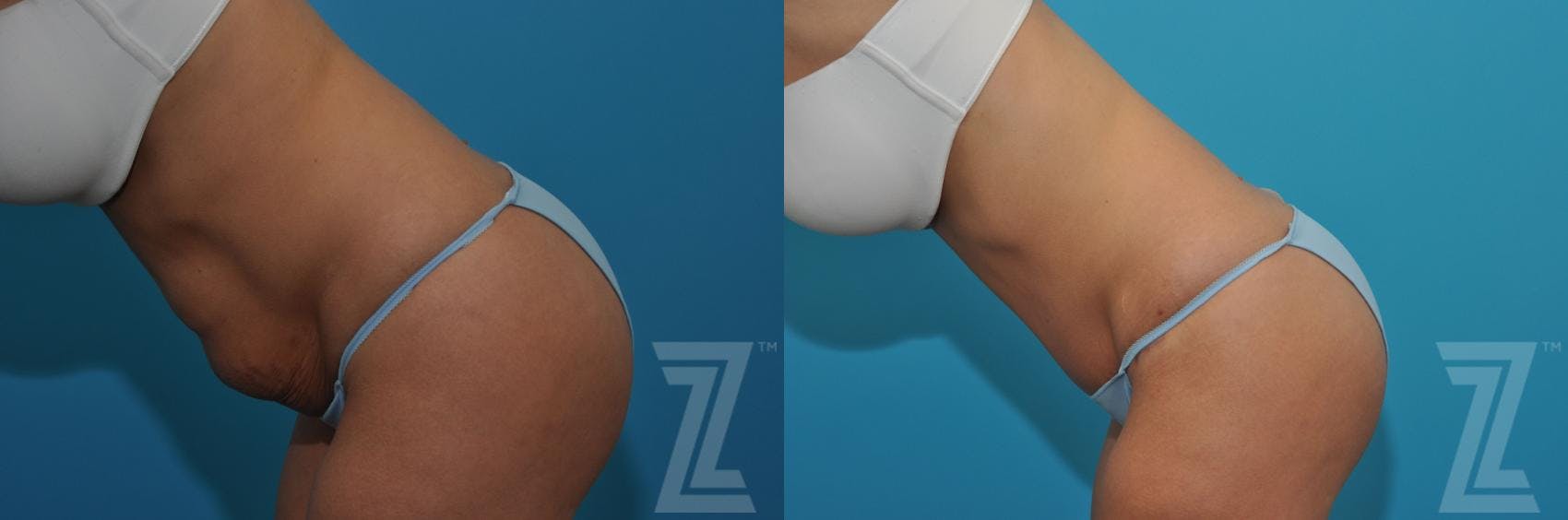 Tummy Tuck Before & After Gallery - Patient 132886876 - Image 3