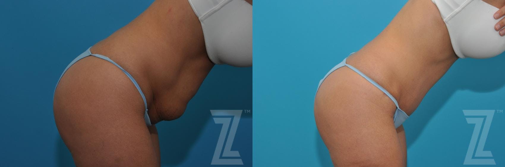Tummy Tuck Before & After Gallery - Patient 132886876 - Image 5