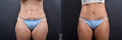 Tummy Tuck Before & After Gallery - Patient 132886877 - Image 1