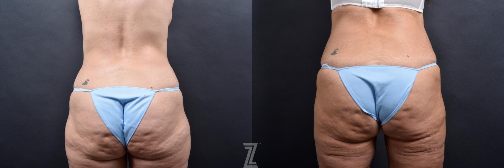 Tummy Tuck Before & After Gallery - Patient 132886877 - Image 4