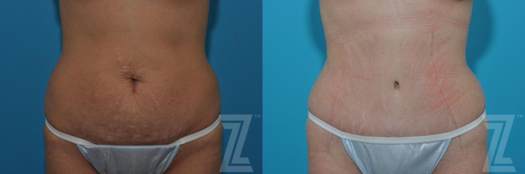 Tummy Tuck Before & After Gallery - Patient 132886879 - Image 1