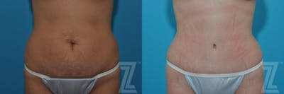 Austin Tummy Tuck Before & After Gallery - Patient 132886879 - Image 1 - The Piazza Center