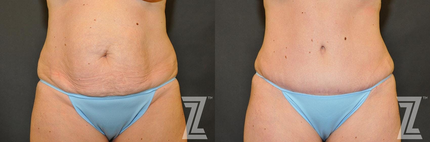 Tummy Tuck Before & After Gallery - Patient 132886883 - Image 1